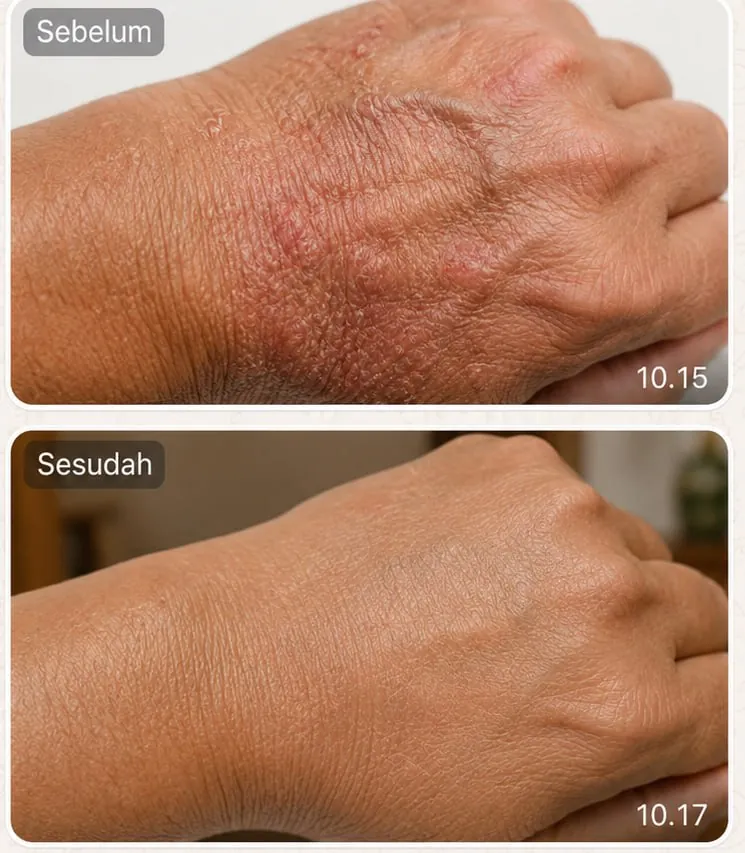 Sebelum dan sesudah pemakaian rutin Taracare Body Lotion