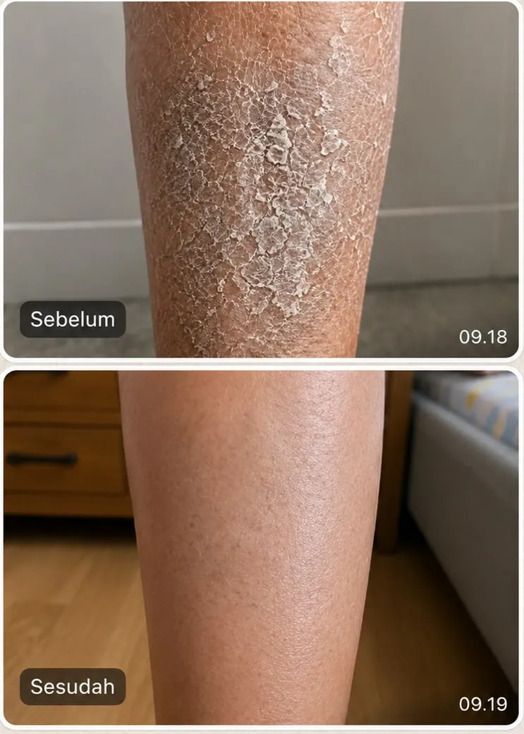 Sebelum dan sesudah pemakaian rutin Taracare Body Lotion