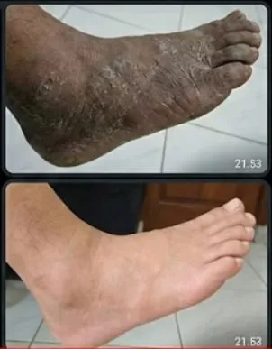 Telapak kaki sebelum dan sesudah pemakaian Taracare