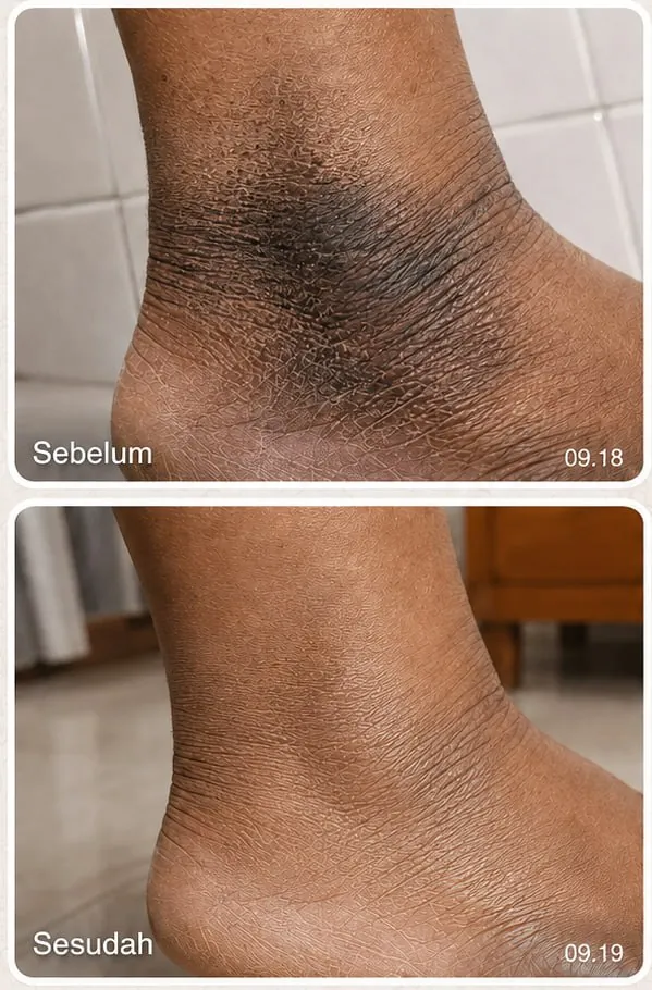 Sebelum dan sesudah pemakaian rutin Taracare Body Lotion